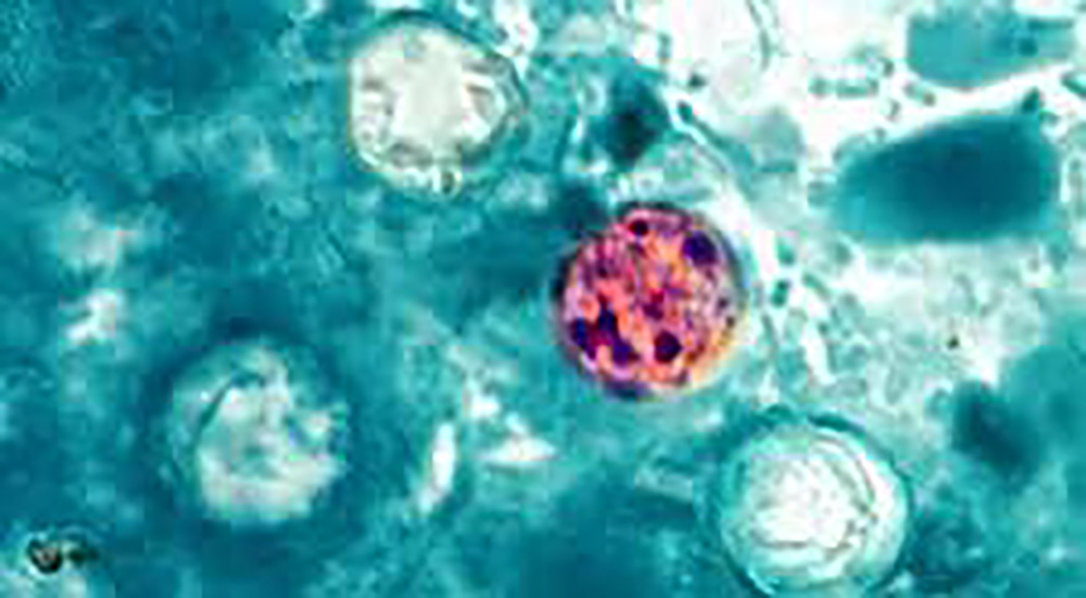 CDC: Cyclosporiasis occurs in many countries, past US cases linked to imported produce